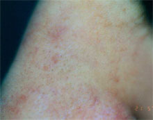After capillary treatment