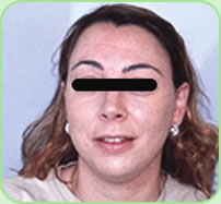 Acne - AFTER treatment