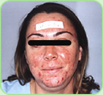 Acne - BEFORE treatment