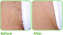 Hair reduction - before and after treatment