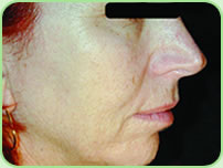 Skin rejuvenation - AFTER