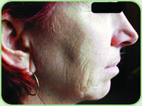Skin rejuvenation - BEFORE